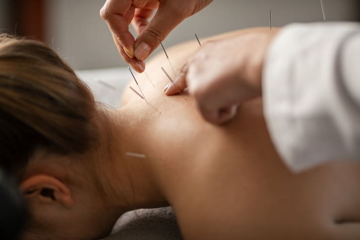 Acupuncture back treatment Acupuncture session with needles inserted along the neck and upper back while lying face down on a table